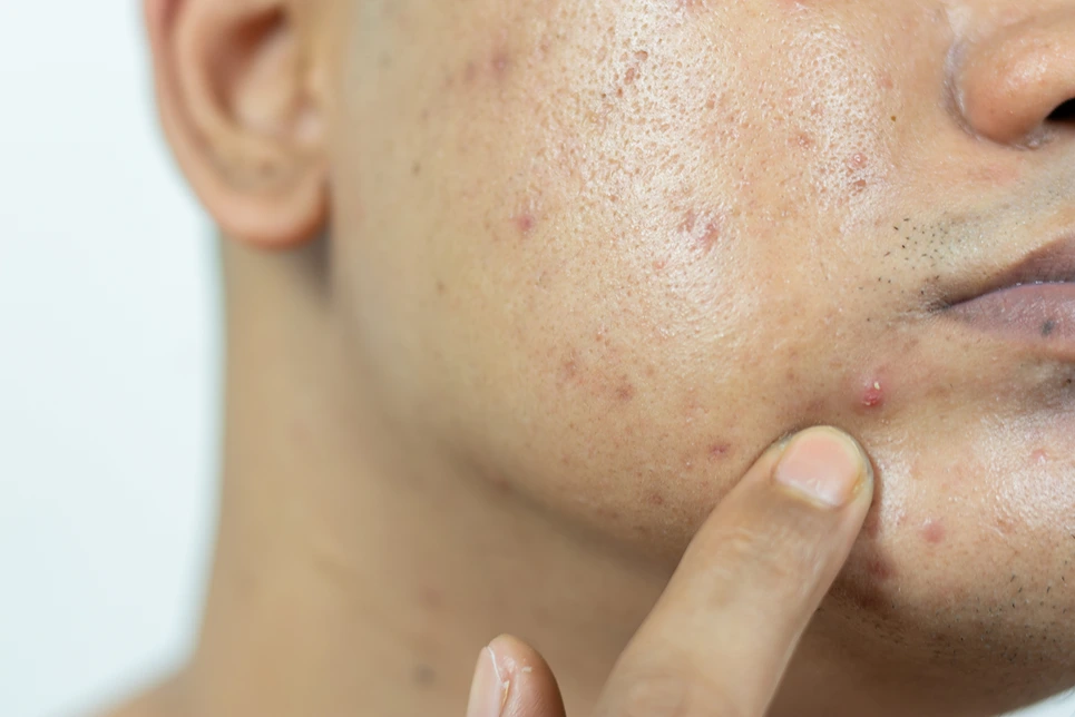 Outsmarting Testosterone Triggered Acne outsmarting-testosterone-triggered-acne
